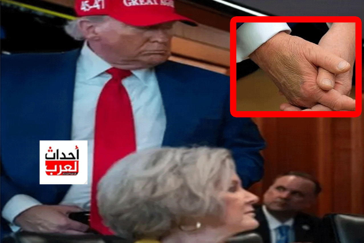 سر الكدمة التي ظهرت في يد ترامب.. ومدى خطورتها الصحية عليه سر الكدمة التي ظهرت في يد ترامب.. ومدى خطورتها الصحية عليه